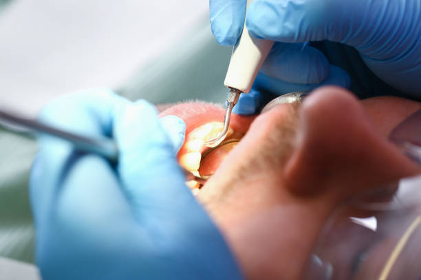 Best Emergency Dentist for Knocked-Out Tooth in Statesville, NC