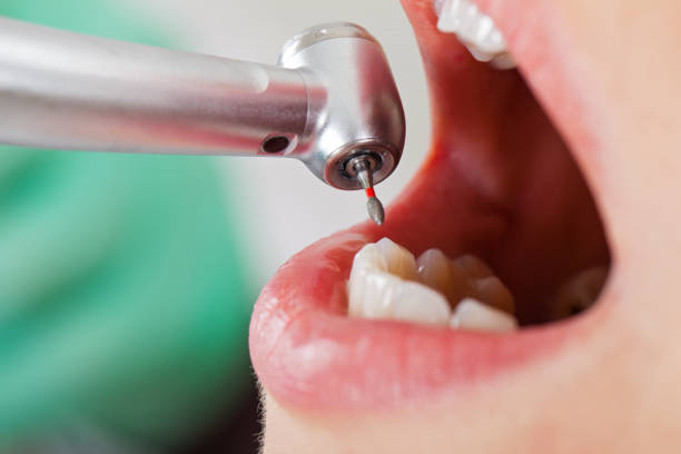 Best Emergency Dental Extractions in Statesville, NC